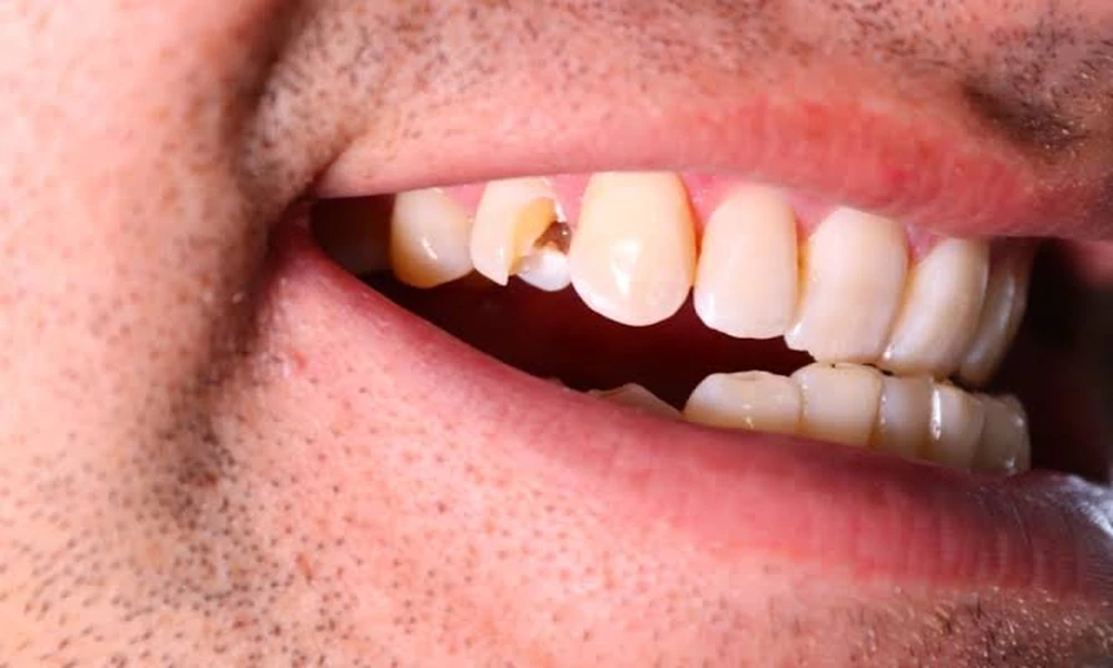 Understanding Impacted Wisdom Teeth: Why Early Diagnosis Can Prevent Serious Dental Problems